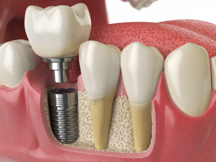 Dental Implants at MediDENT Multicare Clinic