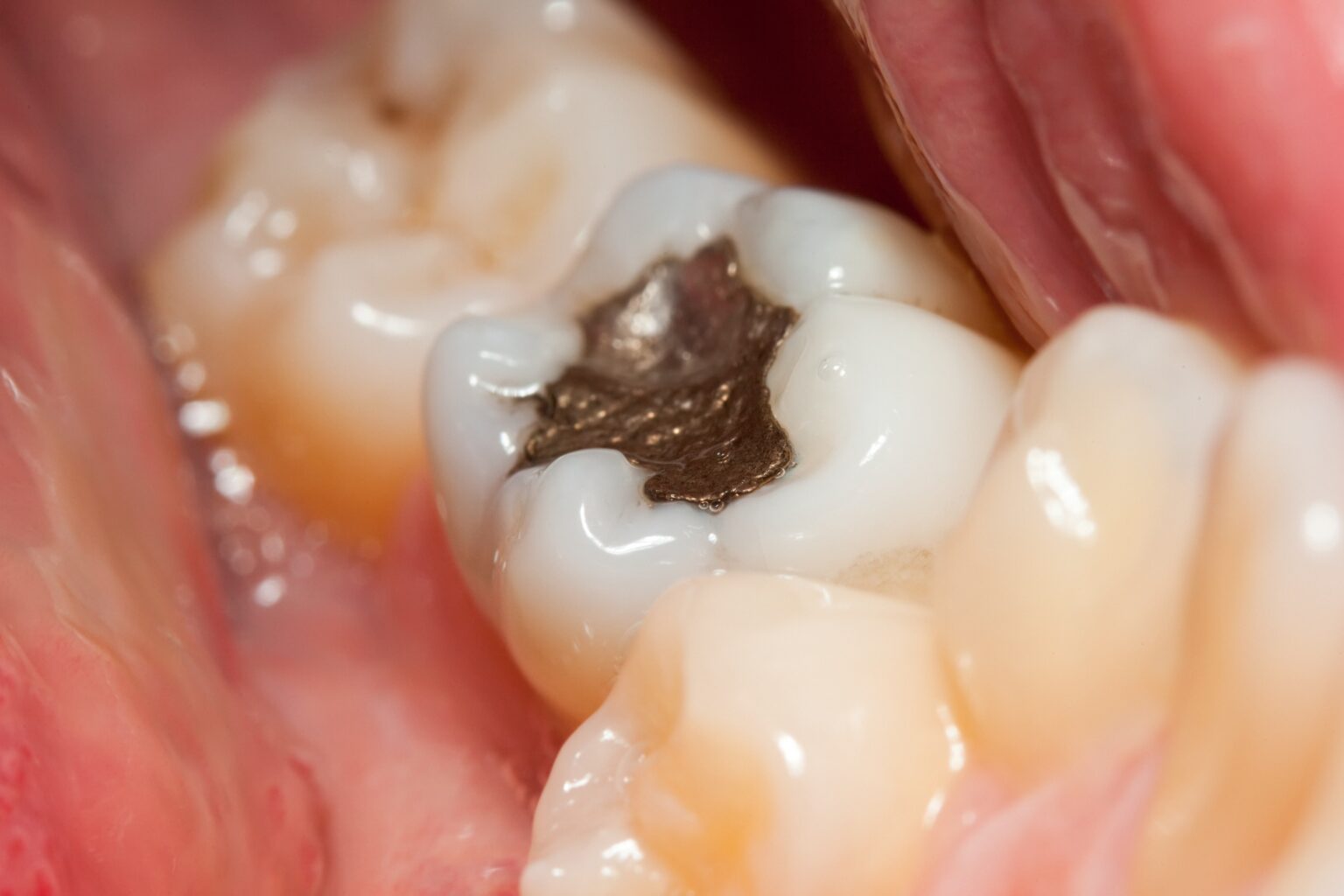 Dental Filling at MediDENT Multicare Clinic