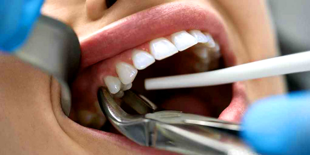 Painless Extraction at MediDENT Multicare Clinic