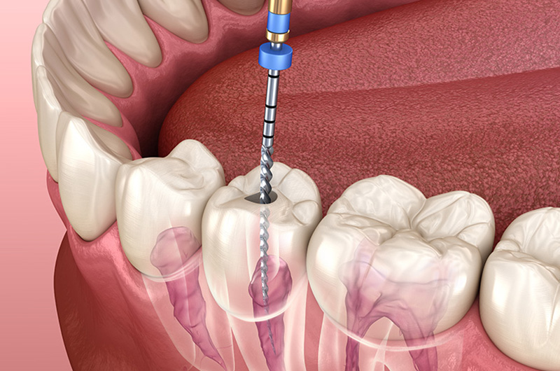 Root Canal Treatment at MediDENT Multicare Clinic